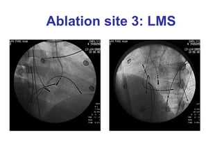 Ablation site 3: LMS
 
