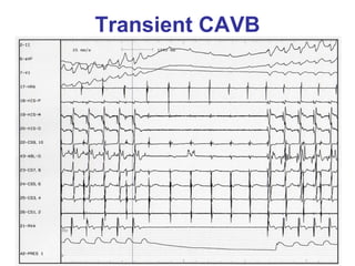 Transient CAVB
 