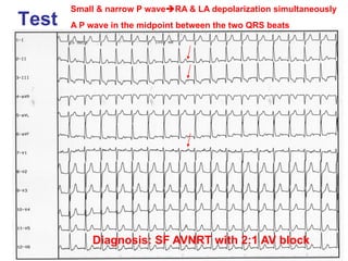 Small & narrow P wave   RA & LA depolarization simultaneously
Test   A P wave in the midpoint between the two QRS beats




            Diagnosis: SF AVNRT with 2:1 AV block
 