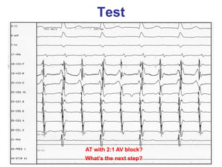Test




AT with 2:1 AV block?
What’s the next step?
 