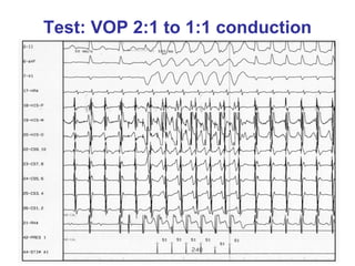 Test: VOP 2:1 to 1:1 conduction
 