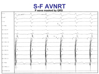 S-F masked by QRS
P wave
       AVNRT
 