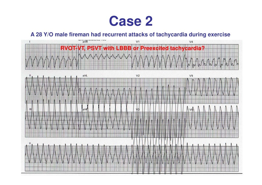 Differentiation between AVNRT and AVRT_advanced lecture