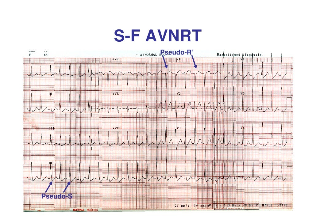 avnrt