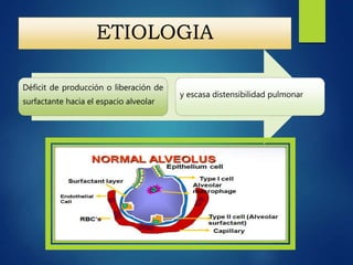 ETIOLOGIA
Déficit de producción o liberación de
surfactante hacia el espacio alveolar
y escasa distensibilidad pulmonar
 