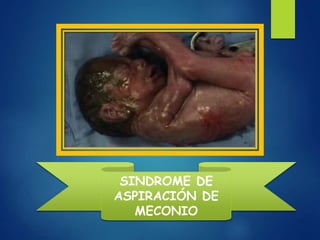 SINDROME DE
ASPIRACIÓN DE
MECONIO
 