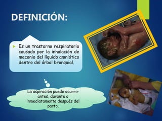 DEFINICIÓN:
 Es un trastorno respiratorio
causado por la inhalación de
meconio del líquido amniótico
dentro del árbol bronquial.
La aspiración puede ocurrir
antes, durante o
inmediatamente después del
parto.
 