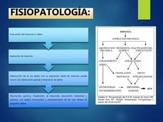 FISIOPATOLOGÍA:
Neumonitis química: Finalmente, se desarrolla neumonitis intersticial y
química, con edema bronquiolar y estrechamiento de las vías aéreas de
pequeño calibre.
Obstrucción de la vía aérea: Con la aspiración distal de meconio puede
ocurrir una obstrucción parcial o total de la vía aérea
Aspiración de meconio
Evacuación del meconio in útero
 