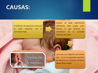 CAUSAS:
El síndrome de aspiración meconial
se suele relacionar con el
sufrimiento fetal.
Cuando un bebé experimenta
sufrimiento fetal puede sufrir
hipoxia, lo que provoca un
incremento de la actividad
intestinal del bebé,
así como una relajación del esfínter
anal , con la consiguiente expulsión
de meconio en el líquido amniótico
donde flota el bebé.
 