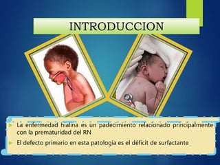 INTRODUCCION
 La enfermedad hialina es un padecimiento relacionado principalmente
con la prematuridad del RN
 El defecto primario en esta patología es el déficit de surfactante
 