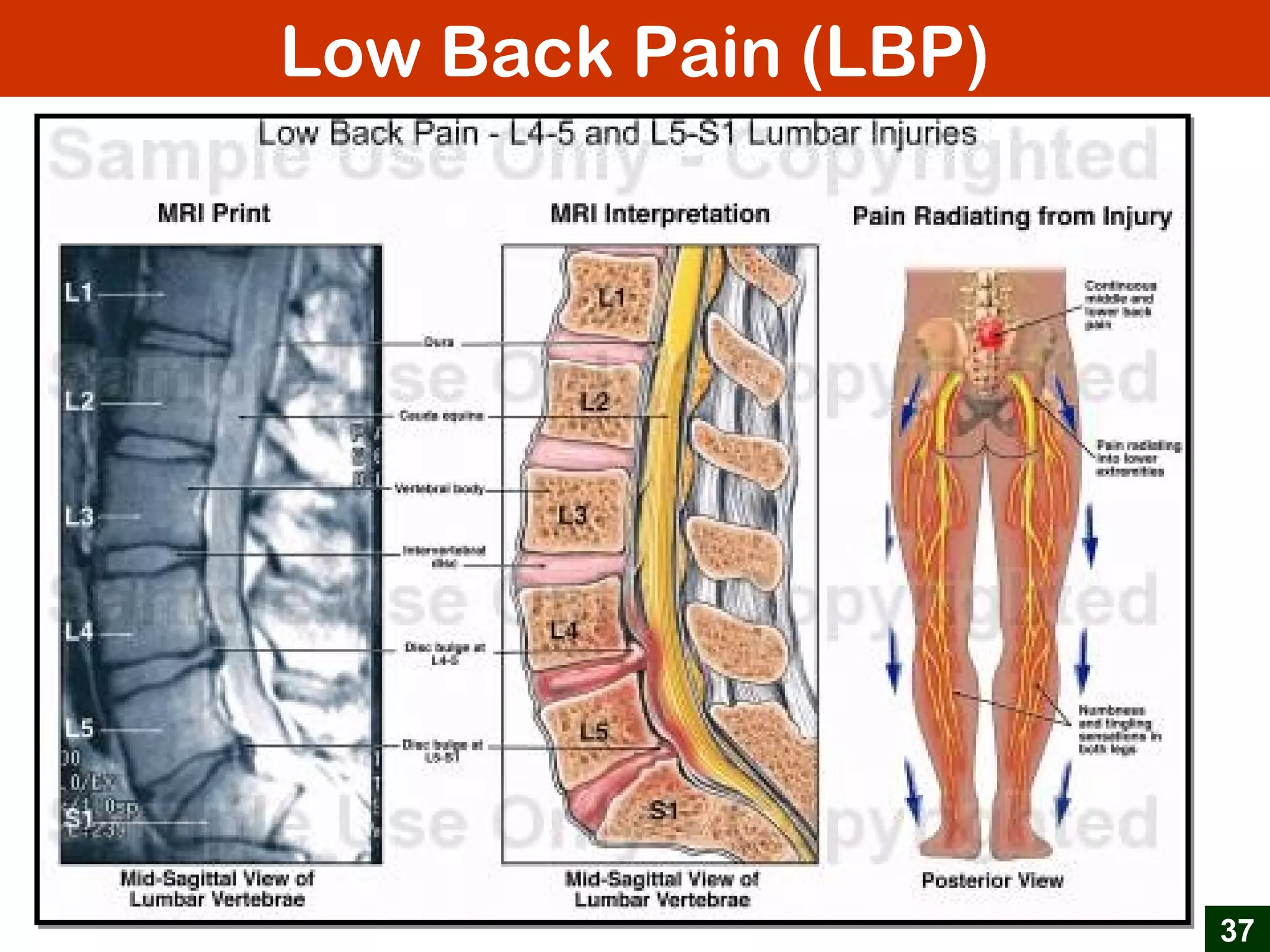 Low Back Pain (LBP)
37
 