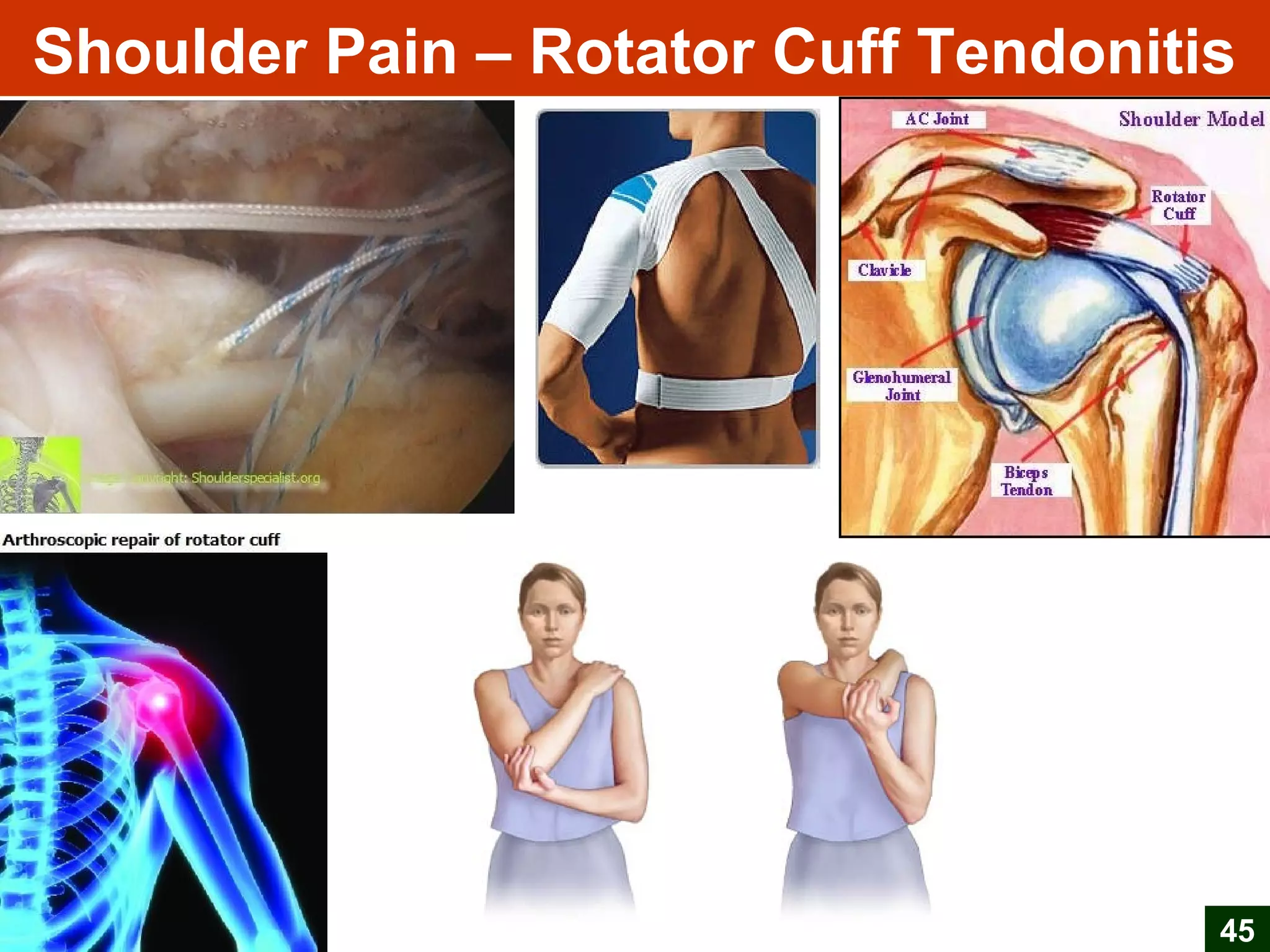 Shoulder Pain – Rotator Cuff Tendonitis
45
 