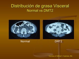 Distribución de grasa Visceral  Normal vs DMT2 Normal DMT2 Courtesy of Wilfred Y. Fujimoto, MD. 