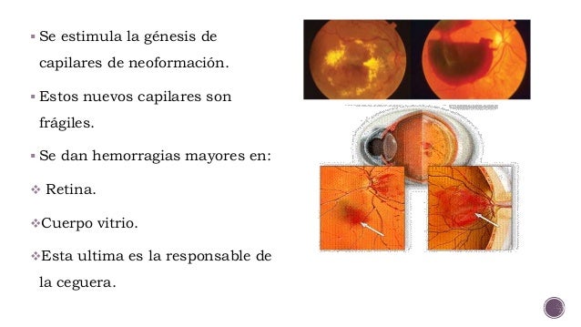 Complicaciones agudas y cronicas de la diabetes mellitus Complicaciones agudas y cronicas de la diabetes mellitus