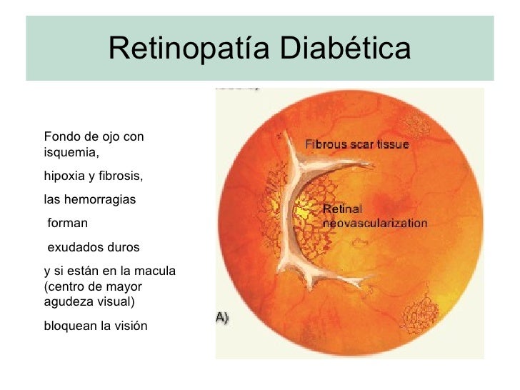 Complicaciones Crónicas Complicaciones Crónicas