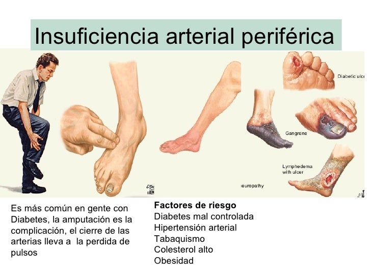 Complicaciones Crónicas Complicaciones Crónicas