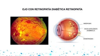 OJO CON RETINOPATÍA DIABÉTICA RETINOPATÍA
 