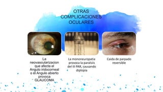 OTRAS
COMPLICACIONES
OCULARES
La
neovascularizacion
que afecta el
Angulo iridocorneal
o el Angulo abierto
provoca
GLAUCOMA
La mononeuropatia
provoca la paralsiis
del III PAR, causando
diplopía
Caida de parpado
reversible
 