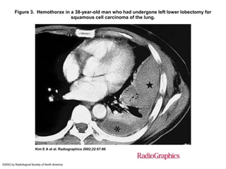 Figure 3. Hemothorax in a 38-year-old man who had undergone left lower lobectomy for
                                 squamous cell carcinoma of the lung.




                        Kim E A et al. Radiographics 2002;22:67-86



©2002 by Radiological Society of North America
 