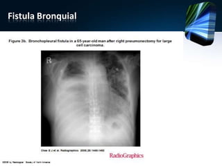 Fistula Bronquial
 
