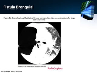 Fistula Bronquial
 