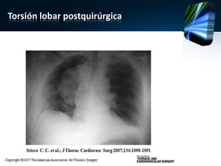 Torsión lobar postquirúrgica
 