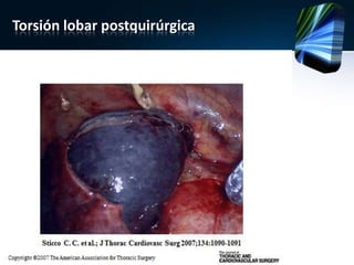 Torsión lobar postquirúrgica
 