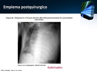 Empiema postquirurgico
 