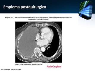 Empiema postquirurgico
 