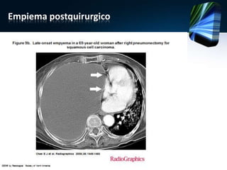 Empiema postquirurgico
 