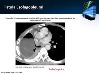Fistula Esofagopleural
 
