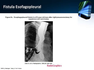 Fistula Esofagopleural
 