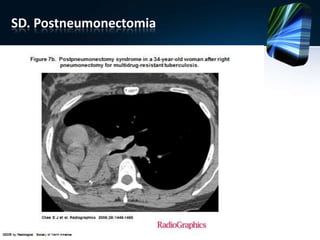 SD. Postneumonectomia
 