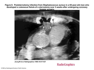 Figure 8. Poststernotomy infection from Staphylococcus aureus in a 65-year-old man who
         developed a cutaneous fistula of a sternotomy scar 3 weeks after undergoing coronary
                                            bypass surgery.




                        Jeung M et al. Radiographics 1999;19:617-637



©1999 by Radiological Society of North America
 