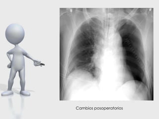 Cambios posoperatorios
 