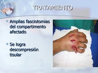 TRATAMIENTO

   Amplias fasciotomias
    del compartimento
    afectado

   Se logra
    descompresión
    tisular
 