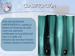 CLASIFICACIÓN


PSEUDOARTROSIS
HIPERTRÓFICA: cuando se
Intenta la formación de callo
como una expresión
exhuberante en la periferia del
trazo y se debe a la
presencia de micromovimiento
 continuo durante el tratamiento
 