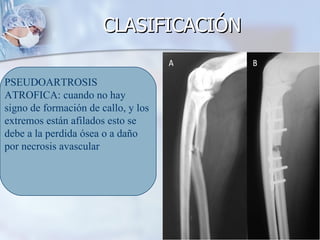 CLASIFICACIÓN

PSEUDOARTROSIS
ATROFICA: cuando no hay
signo de formación de callo, y los
extremos están afilados esto se
debe a la perdida ósea o a daño
por necrosis avascular
 