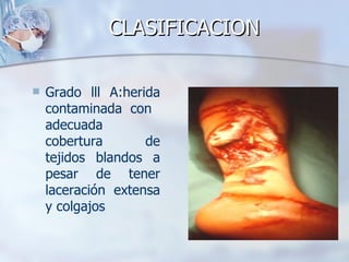 CLASIFICACION

   Grado lll A:herida
    contaminada con
    adecuada
    cobertura       de
    tejidos blandos a
    pesar de tener
    laceración extensa
    y colgajos
 