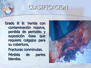 CLASIFICACION

Grado lll B: herida con
  contaminación masiva,
  perdida de periostio y
  exposición ósea que
  requiere colgajos para
  su cobertura,
- Fracturas conminutas.
- Pérdida    de    partes
  blandas.
 