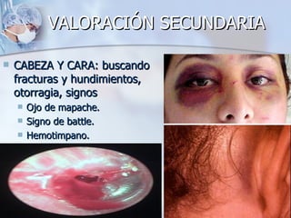 VALORACIÓN SECUNDARIA

   CABEZA Y CARA: buscando
    fracturas y hundimientos,
    otorragia, signos
       Ojo de mapache.
       Signo de battle.
       Hemotimpano.
 