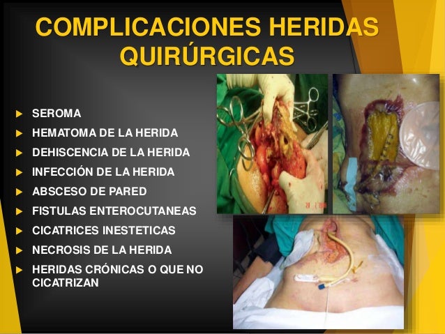 Complicaciones De Las Heridas Quirurgicas