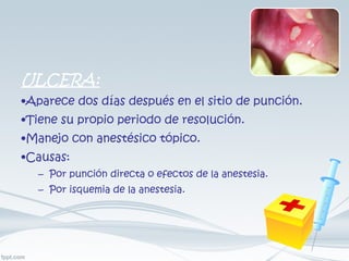 ULCERA: Aparece dos días después en el sitio de punción. Tiene su propio periodo de resolución. Manejo con anestésico tópico. Causas: Por punción directa o efectos de la anestesia. Por isquemia de la anestesia. 