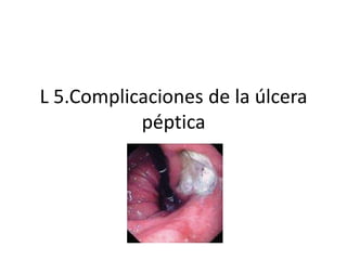 L 5.Complicaciones de la úlcera
péptica
 