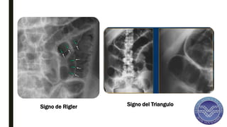 COMPLICACIONES DE ENFERMEDAD ACIDO PEPTICA | PPTX