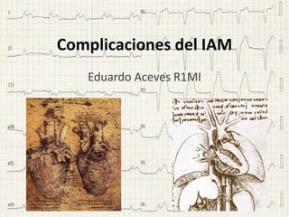 Complicaciones del IAM
   Eduardo Aceves R1MI
 