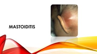 MASTOIDITIS

 