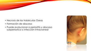• Necrosis de las trabéculas Oseas
• Formación de absceso
• Puede evolucionar a periostitis y absceso
subperiostico o infección intracraneal
 