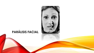 PARÁLISIS FACIAL
 
