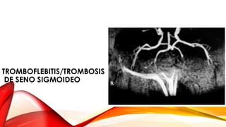 TROMBOFLEBITIS/TROMBOSIS
DE SENO SIGMOIDEO
 